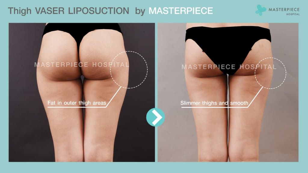 Thigh VASER LIPOSUCTION by MASTERPIECE